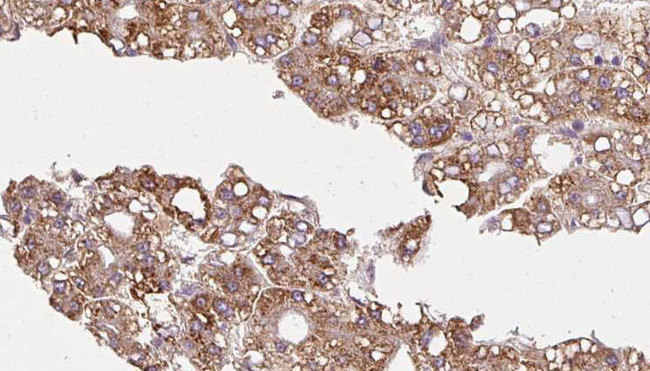 CDC42BPB / MRCKB Antibody - 1:100 staining human liver carcinoma tissues by IHC-P. The sample was formaldehyde fixed and a heat mediated antigen retrieval step in citrate buffer was performed. The sample was then blocked and incubated with the antibody for 1.5 hours at 22°C. An HRP conjugated goat anti-rabbit antibody was used as the secondary.