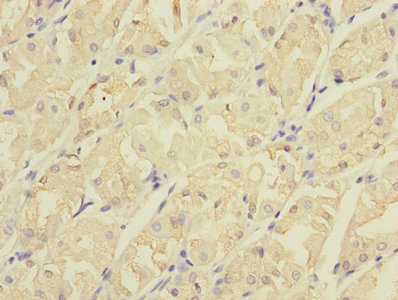 CDC42EP2 Antibody - Immunohistochemistry of paraffin-embedded human gastric cancer using CDC42EP2 Antibody at dilution of 1:100