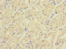 CDC42EP2 Antibody - Immunohistochemistry of paraffin-embedded human gastric cancer using CDC42EP2 Antibody at dilution of 1:100