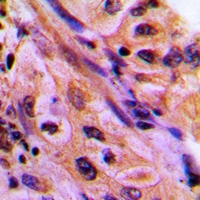 CDC42EP4 / BORG4 Antibody - Immunohistochemical analysis of CDC42EP4 staining in human lung cancer formalin fixed paraffin embedded tissue section. The section was pre-treated using heat mediated antigen retrieval with sodium citrate buffer (pH 6.0). The section was then incubated with the antibody at room temperature and detected with HRP and DAB as chromogen. The section was then counterstained with hematoxylin and mounted with DPX.