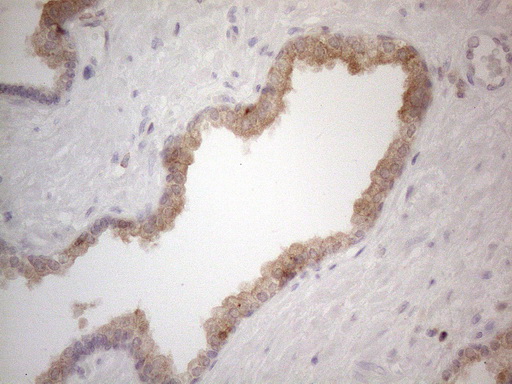 CDC42SE2 Antibody - Immunohistochemical staining of paraffin-embedded Carcinoma of Human prostate tissue using anti-CDC42SE2 mouse monoclonal antibody. (Heat-induced epitope retrieval by 1mM EDTA in 10mM Tris buffer. (pH8.5) at 120°C for 3 min. (1:150)