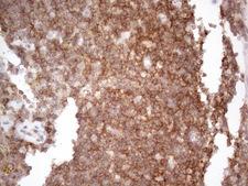 CDC42SE2 Antibody - Immunohistochemical staining of paraffin-embedded Carcinoma of Human thyroid tissue using anti-CDC42SE2 mouse monoclonal antibody. (Heat-induced epitope retrieval by 1mM EDTA in 10mM Tris buffer. (pH8.5) at 120°C for 3 min. (1:150)