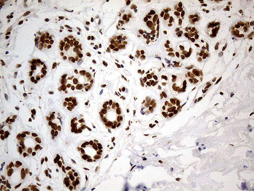 CDC45 Antibody - Immunohistochemical staining of paraffin-embedded Adenocarcinoma of Human breast tissue tissue using anti-CDC45 mouse monoclonal antibody. (Heat-induced epitope retrieval by 1mM EDTA in 10mM Tris buffer. (pH8.5) at 120°C for 3 min. (1:500)