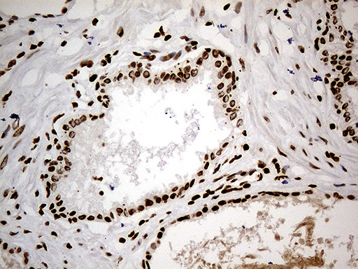 CDC45 Antibody - Immunohistochemical staining of paraffin-embedded Carcinoma of Human prostate tissue using anti-CDC45 mouse monoclonal antibody. (Heat-induced epitope retrieval by 1mM EDTA in 10mM Tris buffer. (pH8.5) at 120°C for 3 min. (1:500)