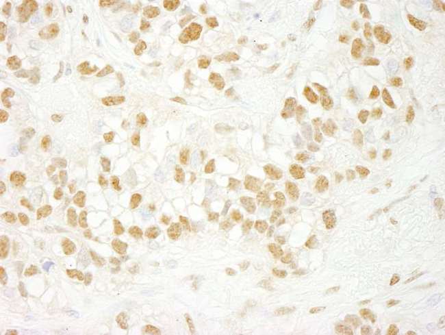CDC5 / CDC5L Antibody - Detection of Human CDC5L by Immunohistochemistry. Sample: FFPE section of human breast carcinoma. Antibody: Affinity purified rabbit anti-CDC5L used at a dilution of 1:250.