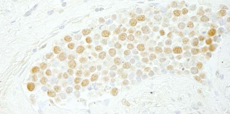 CDC5 / CDC5L Antibody - Detection of Human CDC5L by Immunohistochemistry. Sample: FFPE section of human small cell lung cancer. Antibody: Affinity purified rabbit anti-CDC5L used at a dilution of 1:250.