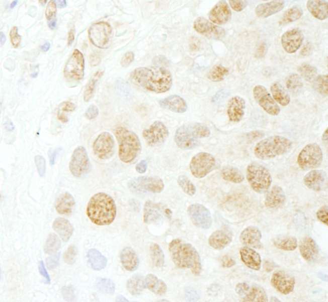 CDC5 / CDC5L Antibody - Detection of Human CDC5L by Immunohistochemistry. Sample: FFPE section of human breast carcinoma. Antibody: Affinity purified rabbit anti-CDC5L used at a dilution of 1:200 (1 ug/ml).