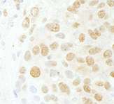 CDC5 / CDC5L Antibody - Detection of Human CDC5L by Immunohistochemistry. Sample: FFPE section of human breast carcinoma. Antibody: Affinity purified rabbit anti-CDC5L used at a dilution of 1:200 (1 ug/ml).