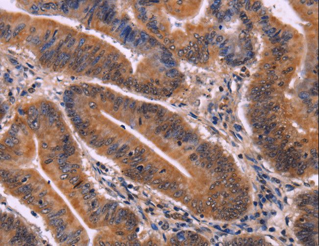 CDC5 / CDC5L Antibody - Immunohistochemistry of paraffin-embedded Human colon cancer using CDC5L Polyclonal Antibody at dilution of 1:40.