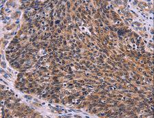 CDC5 / CDC5L Antibody - Immunohistochemistry of paraffin-embedded Human colon cancer using CDC5L Polyclonal Antibody at dilution of 1:30.