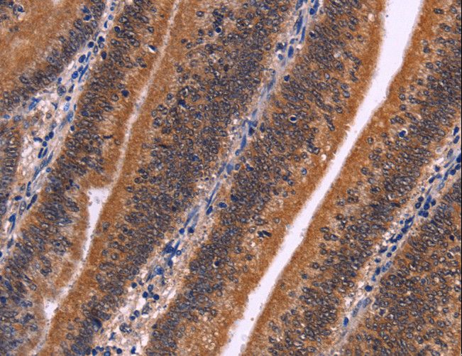 CDC5 / CDC5L Antibody - Immunohistochemistry of paraffin-embedded Human colon cancer using CDC5L Polyclonal Antibody at dilution of 1:30.