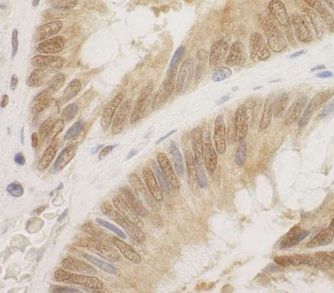 CDC6 Antibody - Detection of Human CDC6 by Immunohistochemistry. Sample: FFPE section of human colon carcinoma. Antibody: Affinity purified rabbit anti-CDC6 used at a dilution of 1:100.