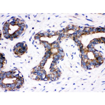 CDC6 Antibody - Cdc6 antibody IHC-paraffin. IHC(P): Human Mammary Cancer Tissue.
