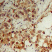CDC6 Antibody - Immunohistochemical analysis of CDC6 staining in human breast cancer formalin fixed paraffin embedded tissue section. The section was pre-treated using heat mediated antigen retrieval with sodium citrate buffer (pH 6.0). The section was then incubated with the antibody at room temperature and detected with HRP and DAB as chromogen. The section was then counterstained with hematoxylin and mounted with DPX.