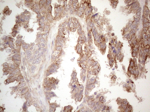 CDC6 Antibody - Immunohistochemical staining of paraffin-embedded Adenocarcinoma of Human ovary tissue using anti-CDC6 mouse monoclonal antibody. (Heat-induced epitope retrieval by 1mM EDTA in 10mM Tris buffer. (pH8.5) at 120°C for 3 min. (1:150)