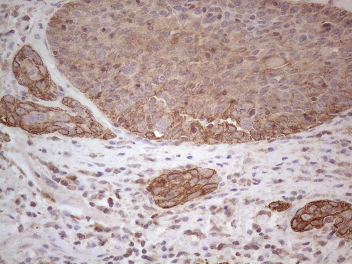 CDC6 Antibody - Immunohistochemical staining of paraffin-embedded Carcinoma of Human bladder tissue using anti-CDC6 mouse monoclonal antibody. (Heat-induced epitope retrieval by 1mM EDTA in 10mM Tris buffer. (pH8.5) at 120°C for 3 min. (1:150)
