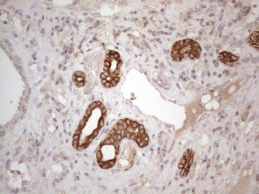 CDC6 Antibody - Immunohistochemical staining of paraffin-embedded Carcinoma of Human liver tissue using anti-CDC6 mouse monoclonal antibody. (Heat-induced epitope retrieval by 1mM EDTA in 10mM Tris buffer. (pH8.5) at 120°C for 3 min. (1:150)