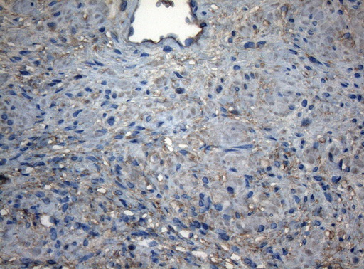 CDC6 Antibody - Immunohistochemical staining of paraffin-embedded Carcinoma of Human prostate tissue using anti-CDC6 mouse monoclonal antibody. (Heat-induced epitope retrieval by 1mM EDTA in 10mM Tris buffer. (pH8.5) at 120°C for 3 min. (1:150)