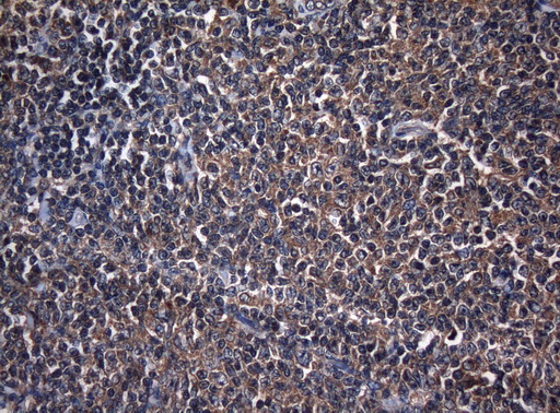 CDC6 Antibody - Immunohistochemical staining of paraffin-embedded Human lymphoma tissue using anti-CDC6 mouse monoclonal antibody. (Heat-induced epitope retrieval by 1mM EDTA in 10mM Tris buffer. (pH8.5) at 120°C for 3 min. (1:150)