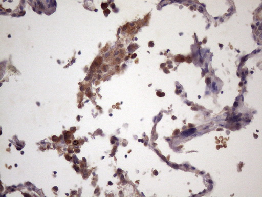 CDC6 Antibody - Immunohistochemical staining of paraffin-embedded Carcinoma of Human lung tissue using anti-CDC6 mouse monoclonal antibody. (Heat-induced epitope retrieval by 1 mM EDTA in 10mM Tris, pH8.5, 120C for 3min. (1:150)