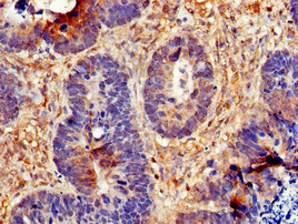 CDC6 Antibody - Immunohistochemistry of paraffin-embedded human ovarian cancer using CDC6 Antibody at dilution of 1:100