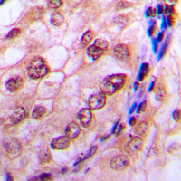 CDC6 Antibody - Immunohistochemical analysis of CDC6 (pS54) staining in human breast cancer formalin fixed paraffin embedded tissue section. The section was pre-treated using heat mediated antigen retrieval with sodium citrate buffer (pH 6.0). The section was then incubated with the antibody at room temperature and detected using an HRP-conjugated compact polymer system. DAB was used as the chromogen. The section was then counterstained with hematoxylin and mounted with DPX.