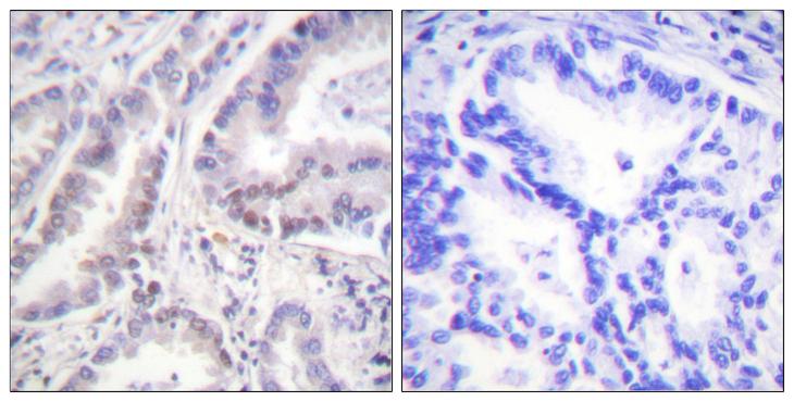 CDC6 Antibody - Peptide - + Immunohistochemistry analysis of paraffin-embedded human lung carcinoma tissue using CDC6 (Ab-54) antibody.