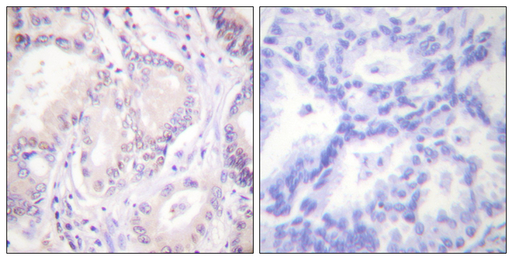 CDC6 Antibody - Immunohistochemistry analysis of paraffin-embedded human lung carcinoma, using CDC6 (Phospho-Ser54) Antibody. The picture on the right is blocked with the phospho peptide.