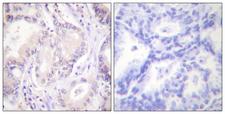 CDC6 Antibody - Immunohistochemistry analysis of paraffin-embedded human lung carcinoma, using CDC6 (Phospho-Ser54) Antibody. The picture on the right is blocked with the phospho peptide.