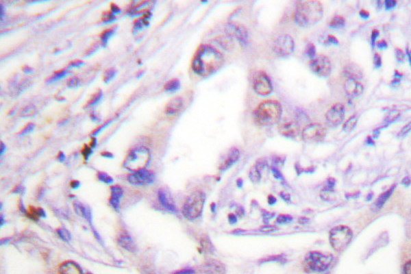 CDC6 Antibody - IHC of CDC6 (V48) pAb in paraffin-embedded human lung carcinoma tissue.