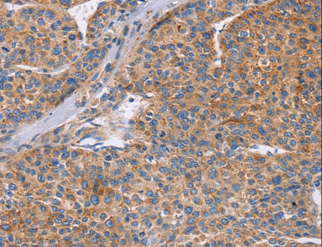 CDC7 Antibody - Immunohistochemistry of paraffin-embedded Human colon cancer using CDC7 Polyclonal Antibody at dilution of 1:70.