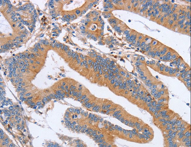 CDC7 Antibody - Immunohistochemistry of paraffin-embedded Human colon cancer using CDC7 Polyclonal Antibody at dilution of 1:70.