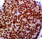 CDC73 / Parafibromin Antibody - IHC of Parafibromin on FFPE Parathyroid Carcinoma Tissue.
