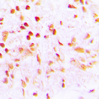 CDCA2 Antibody - Immunohistochemical analysis of CDCA2 staining in human lung cancer formalin fixed paraffin embedded tissue section. The section was pre-treated using heat mediated antigen retrieval with sodium citrate buffer (pH 6.0). The section was then incubated with the antibody at room temperature and detected using an HRP conjugated compact polymer system. DAB was used as the chromogen. The section was then counterstained with hematoxylin and mounted with DPX. w
