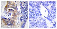 CDCA3 Antibody - Peptide - + Immunohistochemistry analysis of paraffin-embedded human colon carcinoma tissue using CDCA3 antibody.