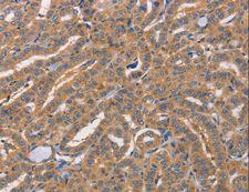 CDCA4 Antibody - Immunohistochemistry of paraffin-embedded Human lung cancer using CDCA4 Polyclonal Antibody at dilution of 1:50.
