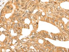 CDCA4 Antibody - Immunohistochemistry of paraffin-embedded Human gastric cancer tissue  using CDCA4 Polyclonal Antibody at dilution of 1:70(×200)