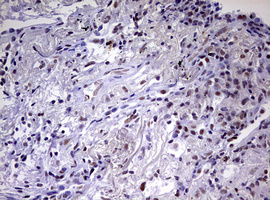 CDCA7L Antibody - IHC of paraffin-embedded Carcinoma of Human lung tissue using anti-CDCA7L mouse monoclonal antibody. (Heat-induced epitope retrieval by 10mM citric buffer, pH6.0, 120°C for 3min).