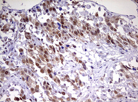 CDCA7L Antibody - IHC of paraffin-embedded Adenocarcinoma of Human ovary tissue using anti-CDCA7L mouse monoclonal antibody. (Heat-induced epitope retrieval by 10mM citric buffer, pH6.0, 120°C for 3min).