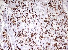 CDCA7L Antibody - IHC of paraffin-embedded Adenocarcinoma of Human breast tissue using anti-CDCA7L mouse monoclonal antibody. (Heat-induced epitope retrieval by 10mM citric buffer, pH6.0, 120°C for 3min).