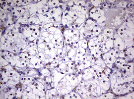 CDCA7L Antibody - IHC of paraffin-embedded Carcinoma of Human kidney tissue using anti-CDCA7L mouse monoclonal antibody. (Heat-induced epitope retrieval by 10mM citric buffer, pH6.0, 120°C for 3min).