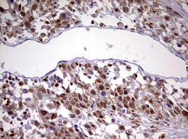 CDCA7L Antibody - IHC of paraffin-embedded Adenocarcinoma of Human ovary tissue using anti-CDCA7L mouse monoclonal antibody. (Heat-induced epitope retrieval by 10mM citric buffer, pH6.0, 120°C for 3min).