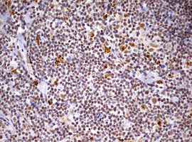 CDCA7L Antibody - IHC of paraffin-embedded Human lymphoma tissue using anti-CDCA7L mouse monoclonal antibody. (Heat-induced epitope retrieval by 10mM citric buffer, pH6.0, 120°C for 3min).