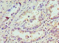 CDCA8 / Borealin Antibody - Immunohistochemistry of paraffin-embedded human lung cancer using antibody at 1:100 dilution.