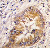 CDCA8 / Borealin Antibody - Formalin-fixed and paraffin-embedded human lung carcinoma tissue reacted with CDCA8 antibody , which was peroxidase-conjugated to the secondary antibody, followed by DAB staining. This data demonstrates the use of this antibody for immunohistochemistry; clinical relevance has not been evaluated.