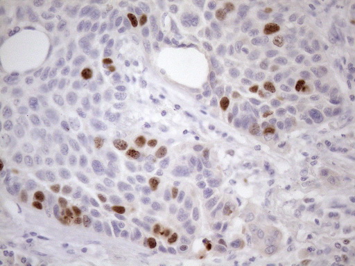 CDCA8 / Borealin Antibody - Immunohistochemical staining of paraffin-embedded Carcinoma of Human lung tissue using anti-CDCA8 mouse monoclonal antibody. (Heat-induced epitope retrieval by 1mM EDTA in 10mM Tris buffer. (pH8.5) at 120 oC for 3 min. (1:150)