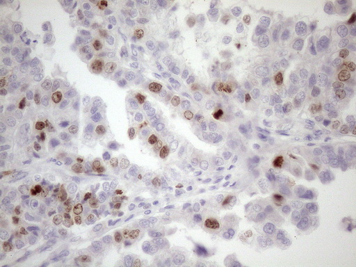 CDCA8 / Borealin Antibody - Immunohistochemical staining of paraffin-embedded Adenocarcinoma of Human ovary tissue using anti-CDCA8 mouse monoclonal antibody. (Heat-induced epitope retrieval by 1mM EDTA in 10mM Tris buffer. (pH8.5) at 120 oC for 3 min. (1:150)