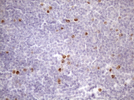 CDCA8 / Borealin Antibody - Immunohistochemical staining of paraffin-embedded Human lymphoma tissue using anti-CDCA8 mouse monoclonal antibody. (Heat-induced epitope retrieval by 1mM EDTA in 10mM Tris buffer. (pH8.5) at 120 oC for 3 min. (1:150)