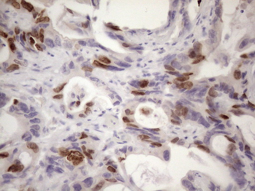 CDCA8 / Borealin Antibody - Immunohistochemical staining of paraffin-embedded Adenocarcinoma of Human colon tissue using anti-CDCA8 mouse monoclonal antibody. (Heat-induced epitope retrieval by 1mM EDTA in 10mM Tris buffer. (pH8.5) at 120 oC for 3 min. (1:150)