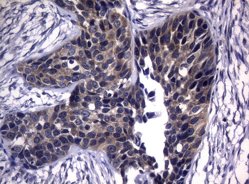 CDCA8 / Borealin Antibody - Immunohistochemical staining of paraffin-embedded Carcinoma of Human kidney tissue using anti-CDCA8 mouse monoclonal antibody. (Heat-induced epitope retrieval by 1mM EDTA in 10mM Tris buffer. (pH8.5) at 120°C for 3 min. (1:150)